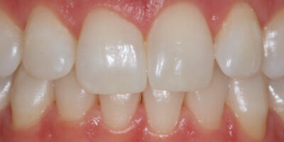 Before - New River Dental Enfield
