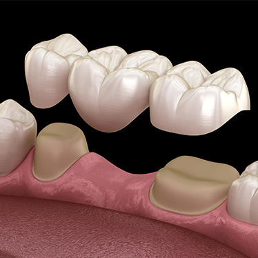 Dental-bridges