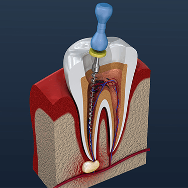 Root-canal-treatment