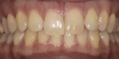 Before - New River Dental Enfield