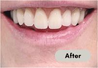 After-denture