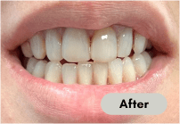 After-denture