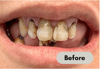 before-denture-care