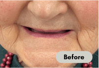 before-denture-care