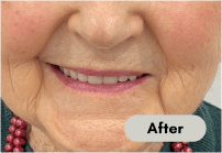 after-denture