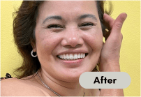 After-denture