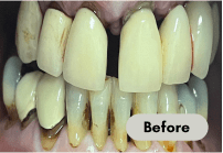 before-denture-care