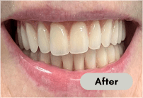 After-dentures