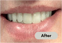 After-denture