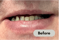 before-denture-care