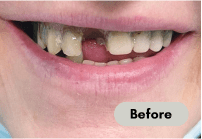 before-denture-care