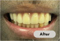 After-dentures