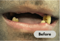 before-denture-care