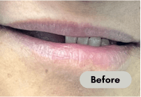 before-denture-care