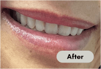 After-dentures