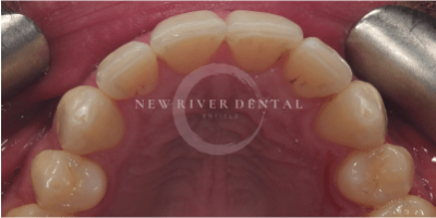 Invisalign before-2
