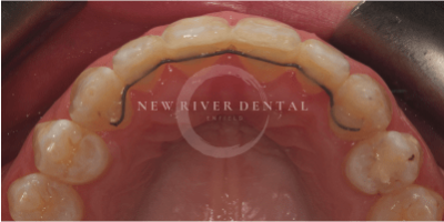 Invisalign-before-3