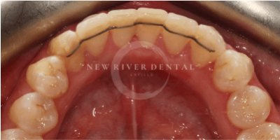 invisalign-before-33b