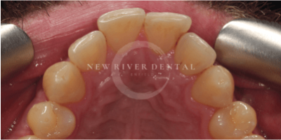 Invisalign before-2