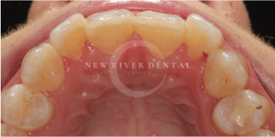 Invisalign-before-3