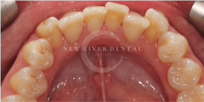 invisalign-before-33b