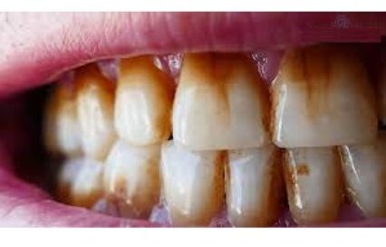yellow and discoloured teeth treatment