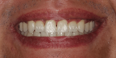 teeth whitening after case 4
