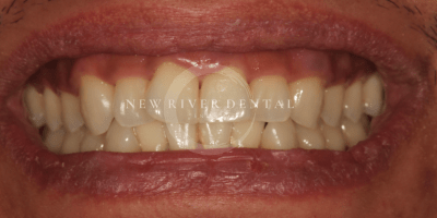 teeth whitening before case 4