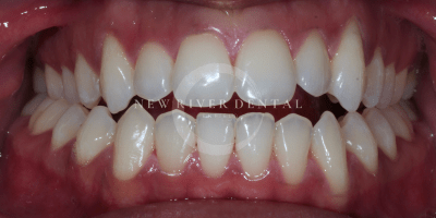 teeth whitening after treatment