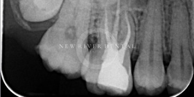 Endodontic after