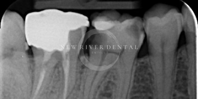 Endodontic after