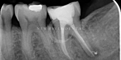 Endodontic after