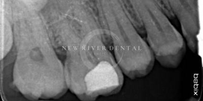 Endodontic Before 