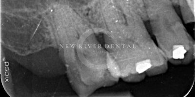 Endodontic Before 