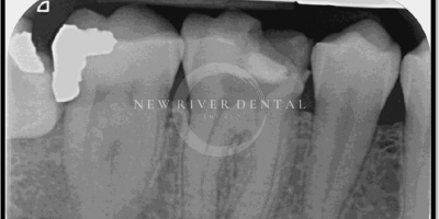 Endodontic Before 