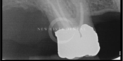Endodontic Before 