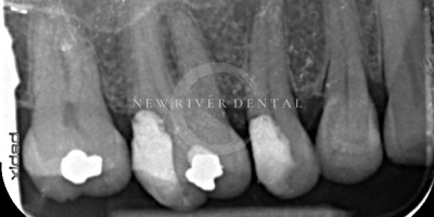 Endodontic Before 