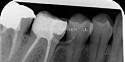 Endodontic Before 