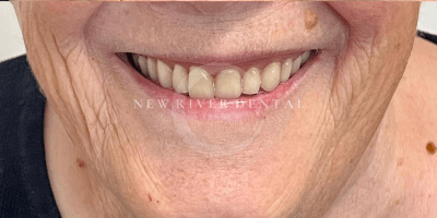Dentures After